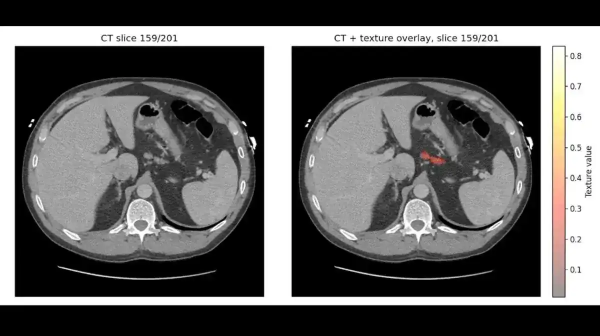 🔬 Mayo Clinic人工智能提前3年发现胰腺癌